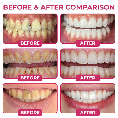 🇺🇸Trilumia® DenPerm🦷 Cavity-Repair Natural Enamel Filling Gel🌸