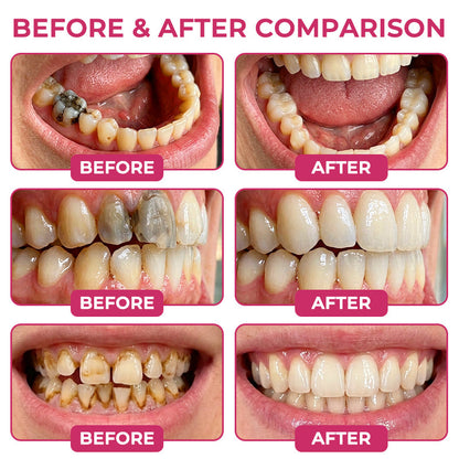 🇺🇸Trilumia® DenPerm🦷 Cavity-Repair Natural Enamel Filling Gel🌸